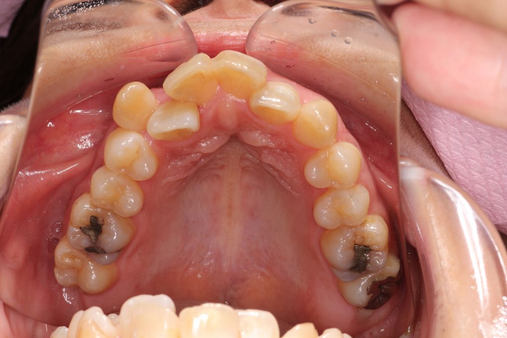 実例あり 固定式フィックスリテーナー 千葉県八千代市の矯正歯科専門医 まきの歯列矯正クリニック