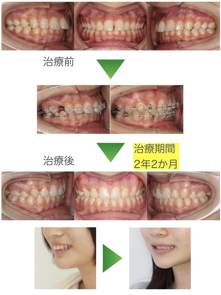 上顎前突