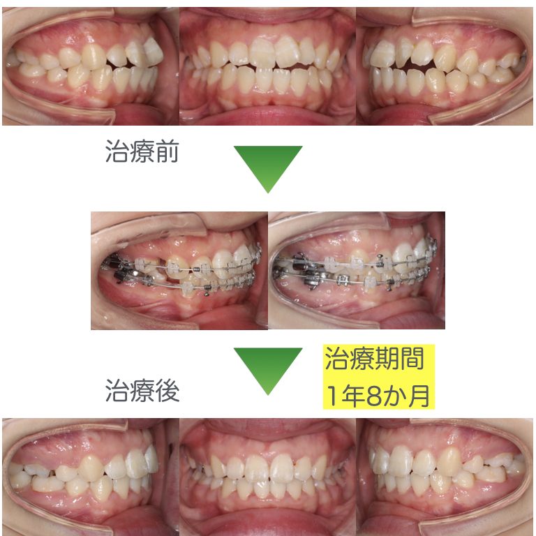 開咬・抜歯症例3