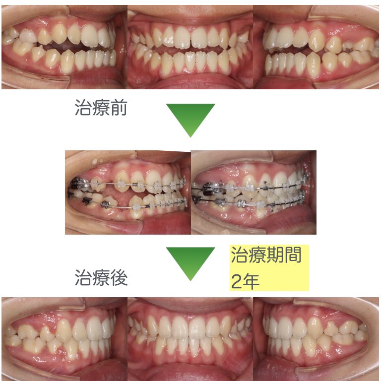 開咬・抜歯矯正２