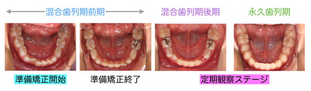 混合歯列期後期　矯正歯科治療