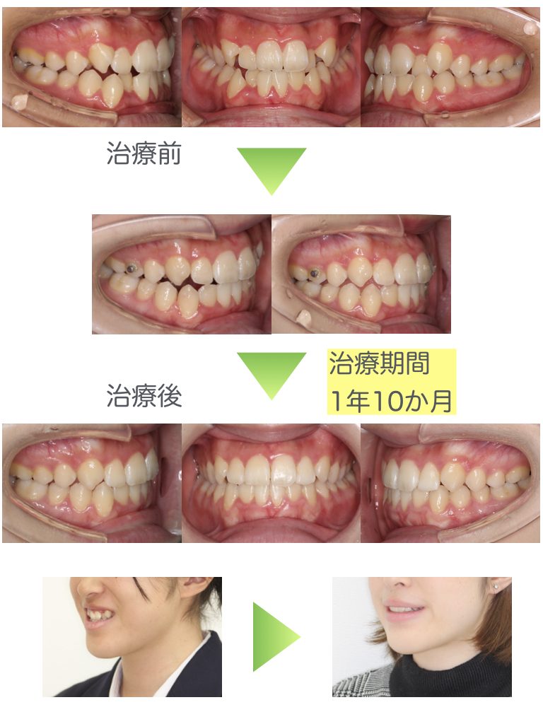 受け口 反対咬合 の矯正治療 千葉県八千代市の矯正歯科専門医 まきの歯列矯正クリニック