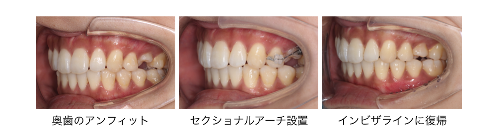 インビザライン矯正のリカバリー方法 | 千葉県八千代市の矯正歯科専門 