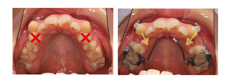 <第一小臼歯を抜歯して歯列を整える一般的な矯正治療>