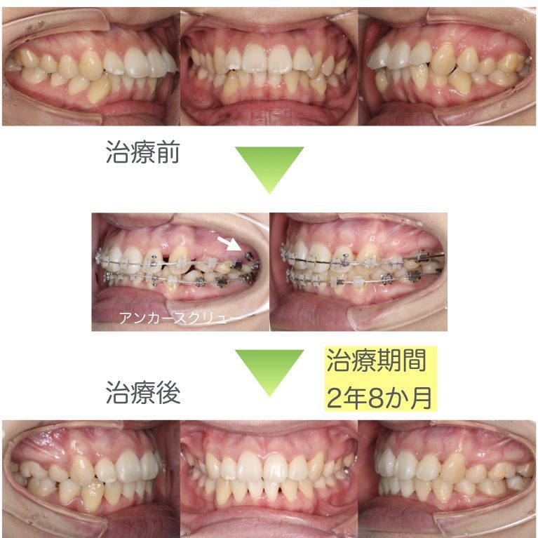表側矯正装置症例集 千葉県八千代市の矯正歯科専門医 まきの歯列矯正クリニック