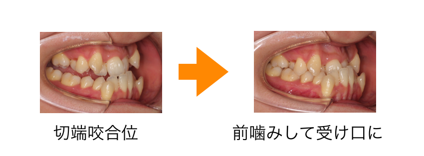 切端咬合