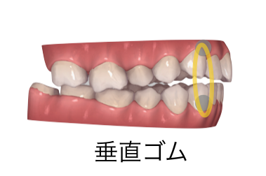 大事な】顎間ゴム（エラスティック） | 千葉県八千代市の矯正歯科専門医院【まきの歯列矯正クリニック】
