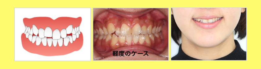 叢生・症状