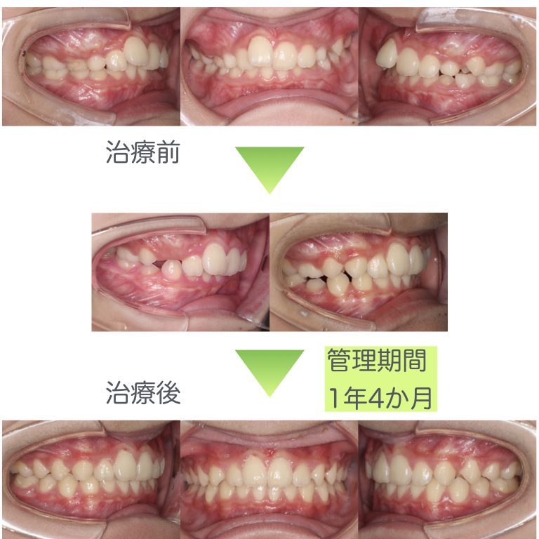 出っ歯 上顎前突 の矯正治療 千葉県八千代市の矯正歯科専門医 まきの歯列矯正クリニック