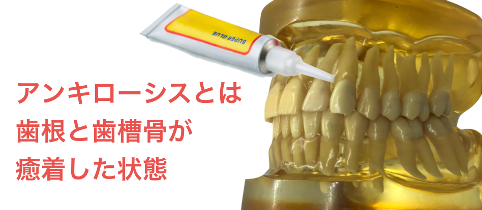 アンキローシスは歯根と歯槽骨が癒着した状態
