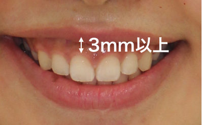 3mm以上歯茎がみえるガミースマイル