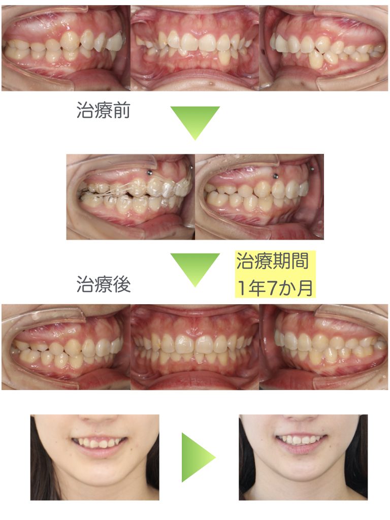 Deep bite, Gummy smile, Anchor screw, Extraction, Adult, Invisalign