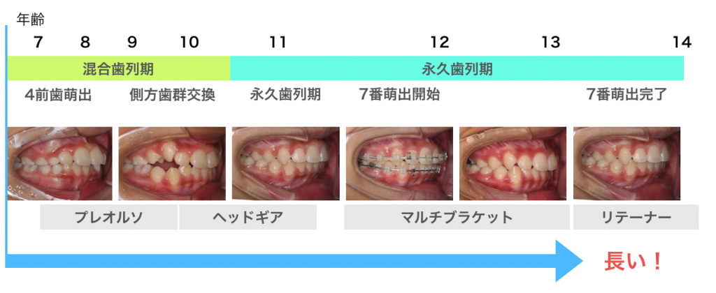 列 いい やめた 歯 矯正 ほうが 裏側・舌側・リンガル矯正は痛い？メリットとデメリット｜歯科衛生士がお口の悩みに答えます