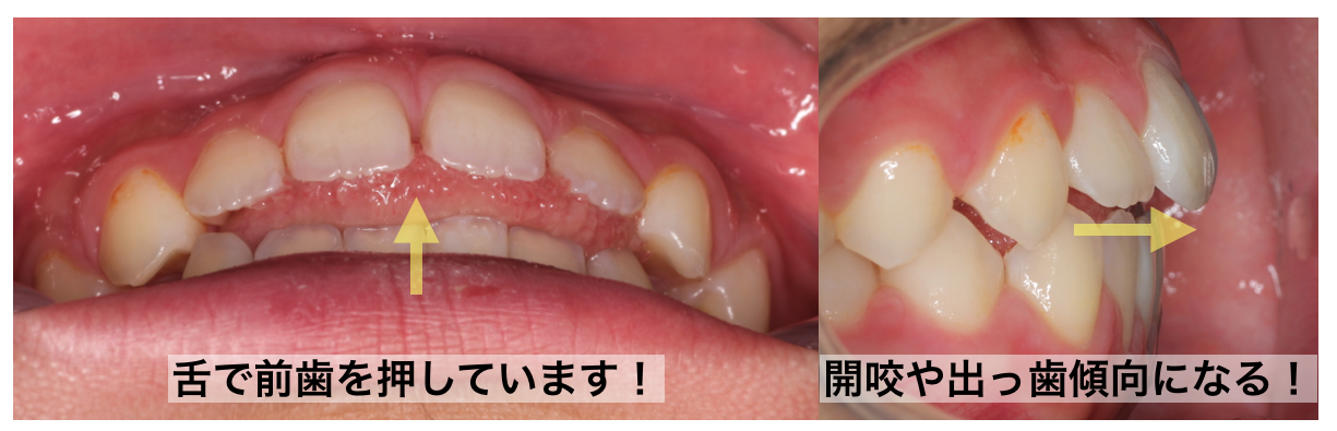 低位舌の歯列への影響