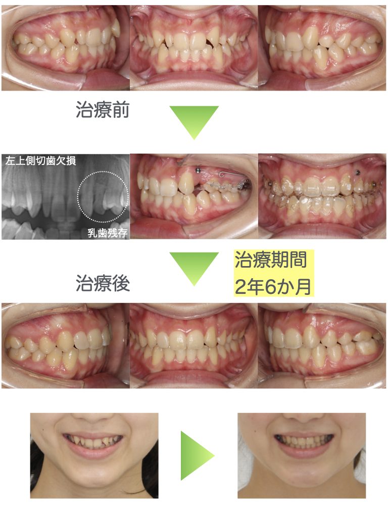 矮小歯・先天性欠如歯