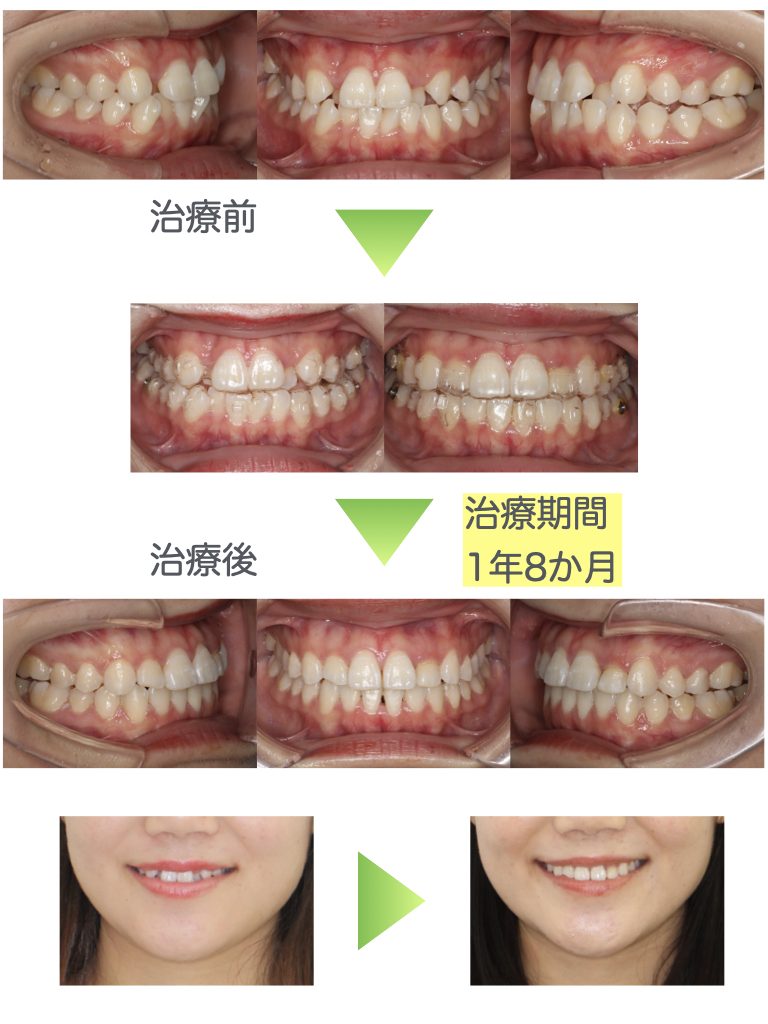インビザライン症例集 千葉県八千代市の矯正歯科専門医 まきの歯列矯正クリニック