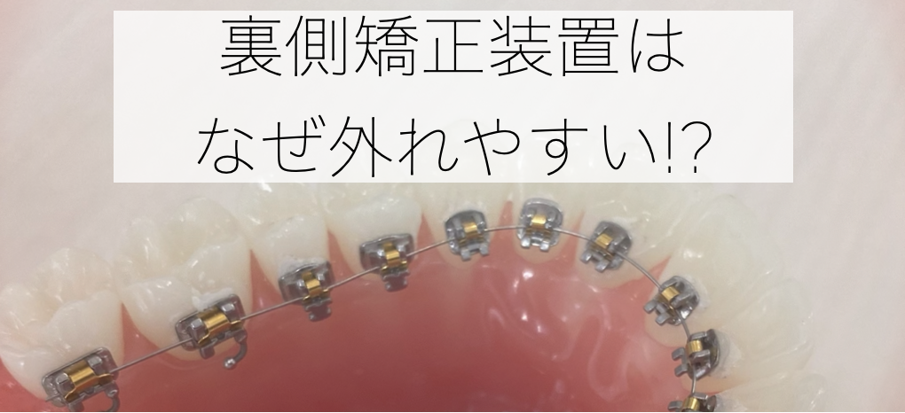 裏側につける矯正装置が外れやすい理由