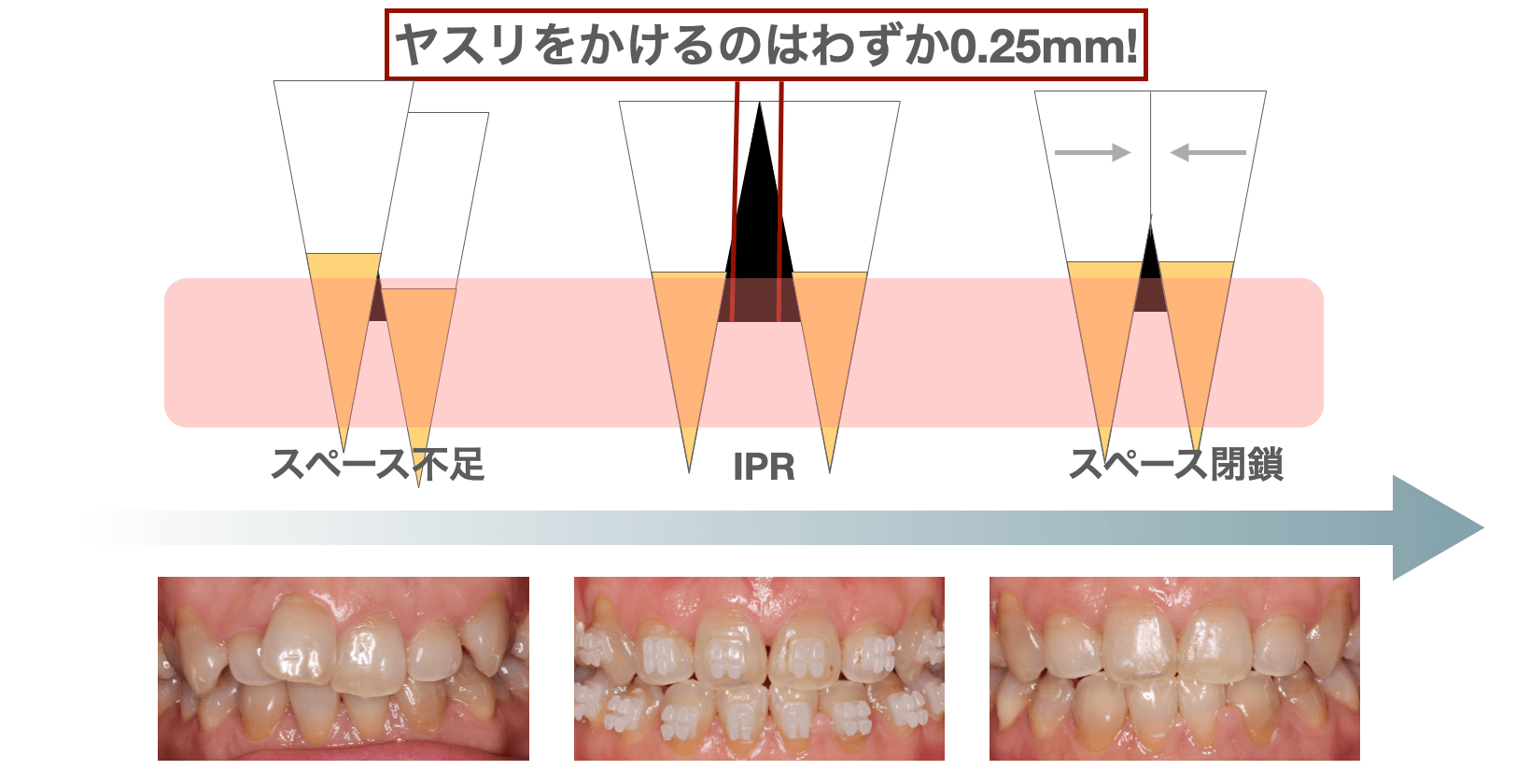 矯正治療で歯を削る事も?(IPR・ストリッピング) | 千葉県八千代市の矯正歯科専門医院【まきの歯列矯正クリニック】