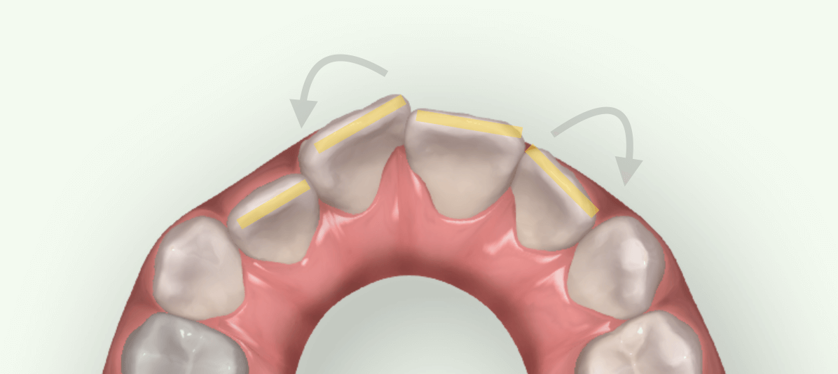 <前歯のねじれによる不揃い>