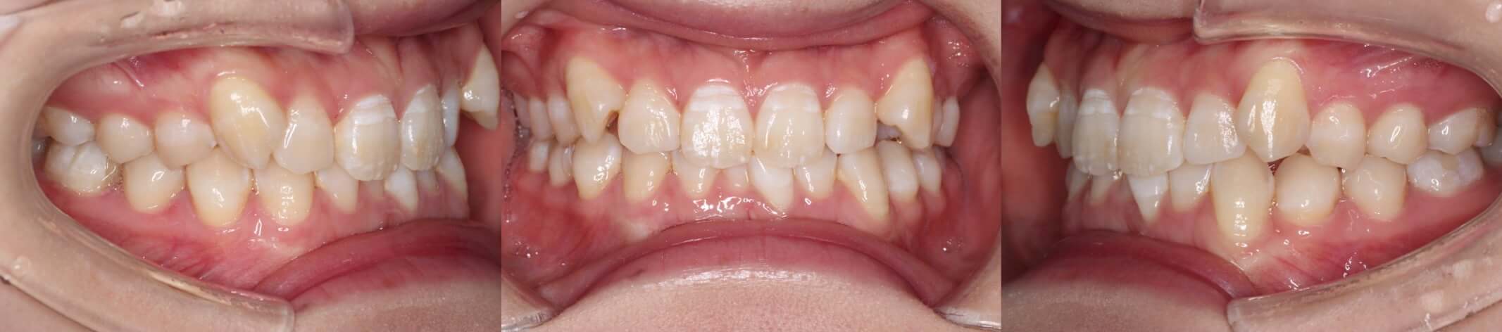 八重歯・インビザライン治療症例