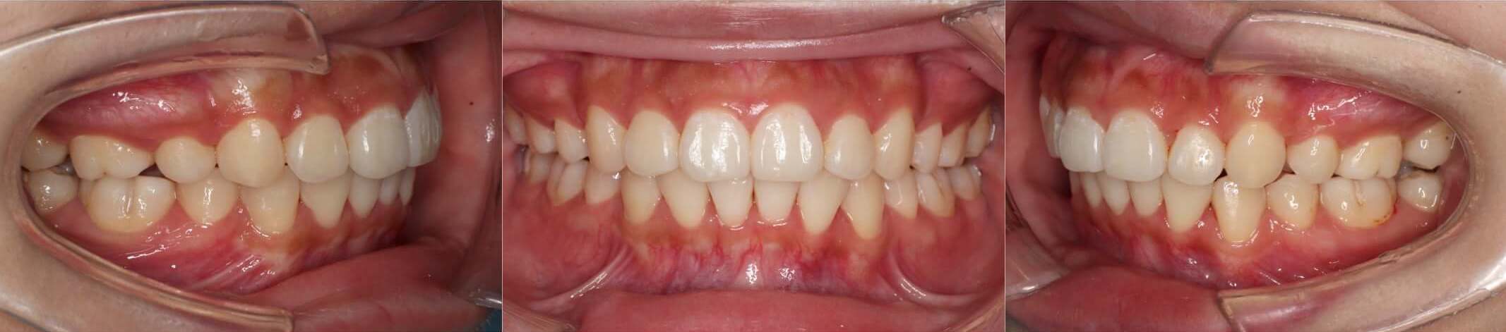 出っ歯インビザライン治療症例2