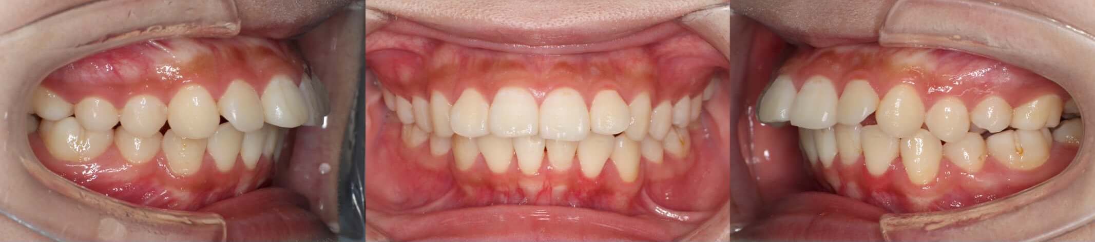 出っ歯インビザライン治療症例2