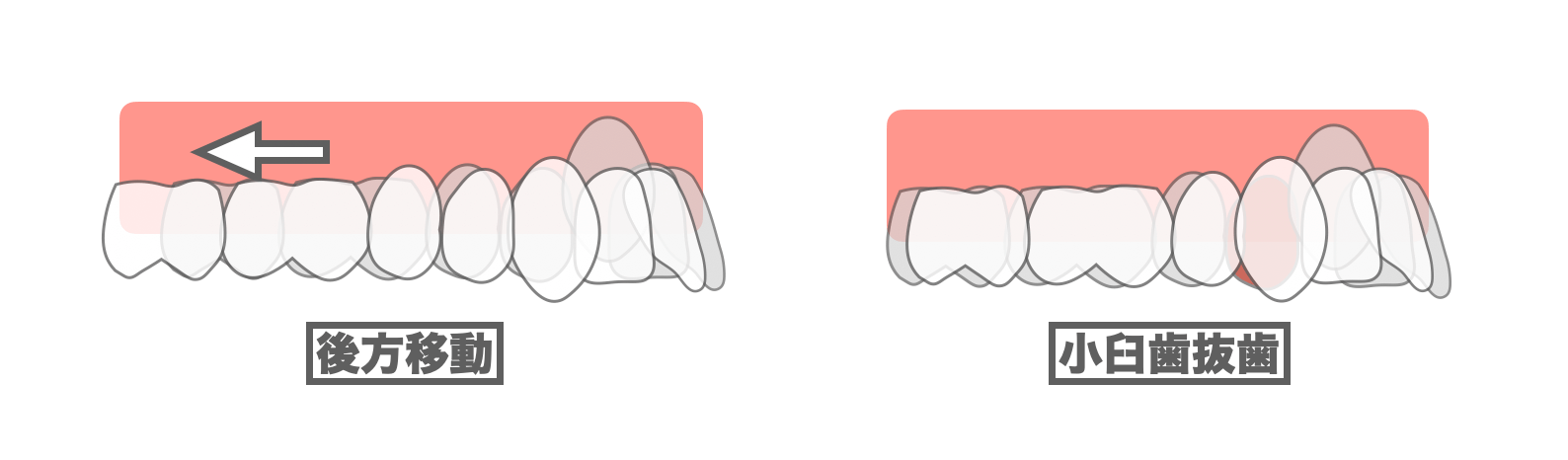 後方移動と小臼歯抜歯の比較・インビザライン