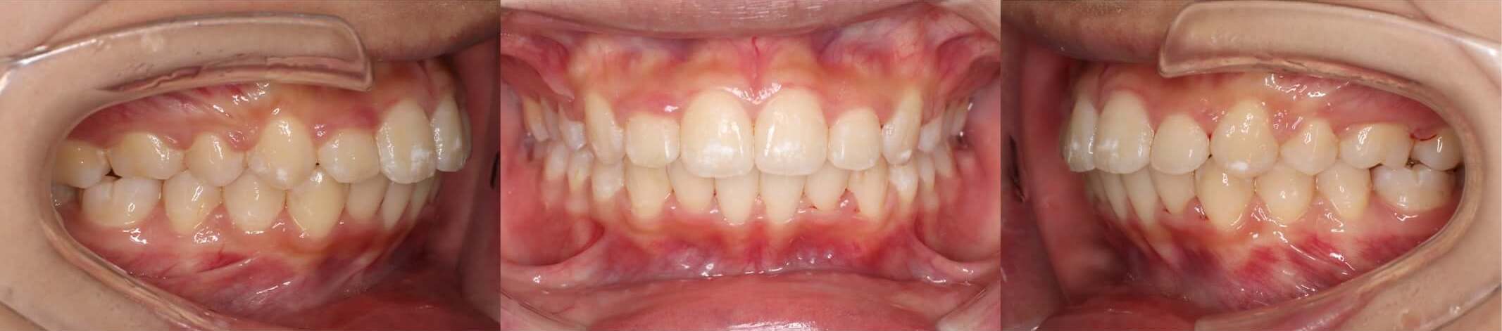 出っ歯抜歯治療症例