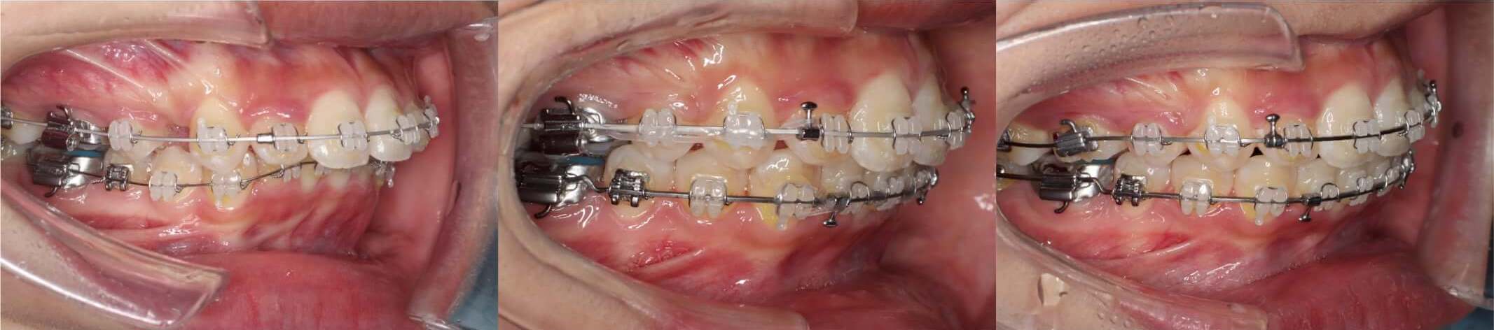 出っ歯抜歯治療症例