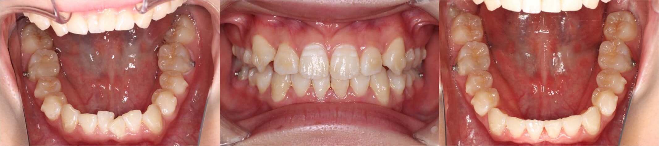 八重歯・インビザライン治療症例