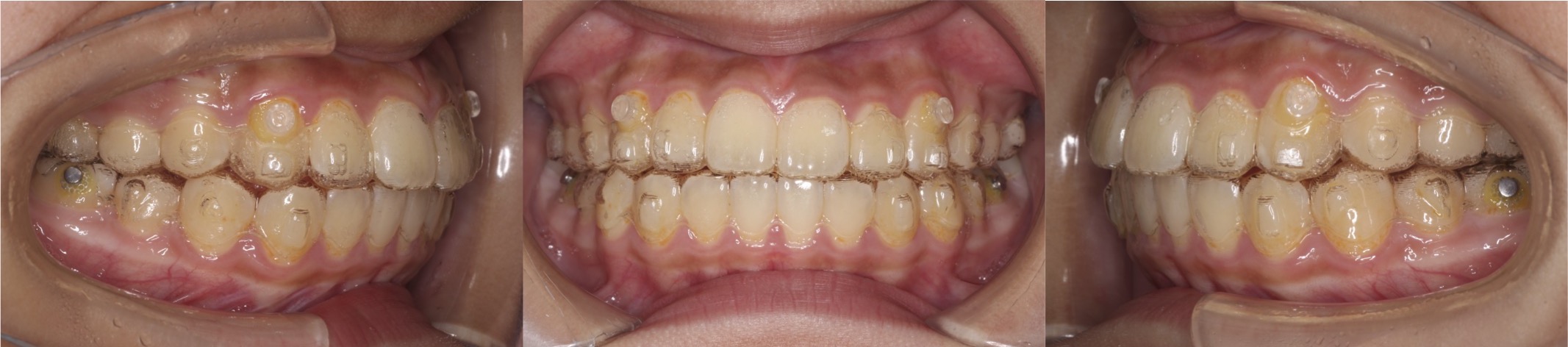 出っ歯インビザライン治療症例1