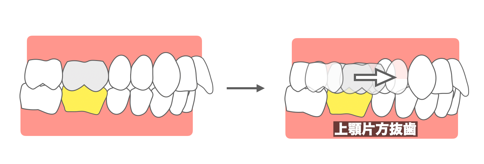 2級仕上げの歯の動かし方