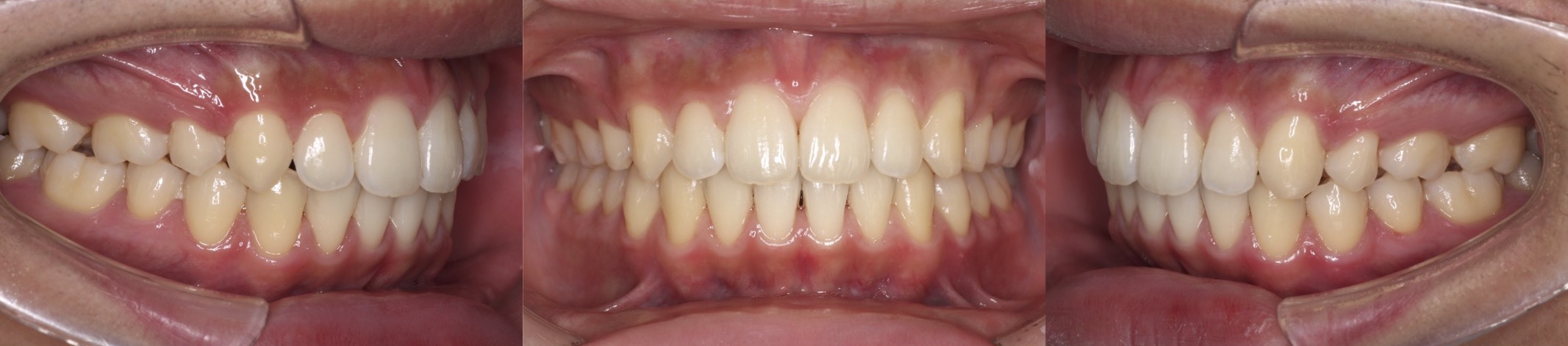 出っ歯インビザライン治療症例3