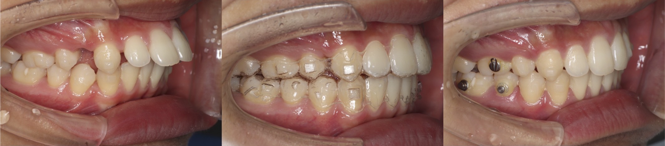インビザライン・上顎前突抜歯症例