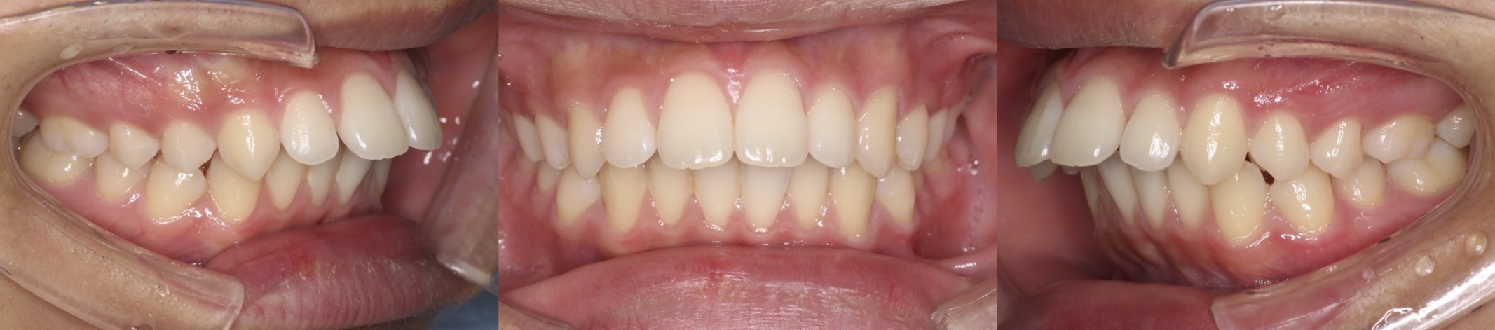 出っ歯インビザライン治療症例3