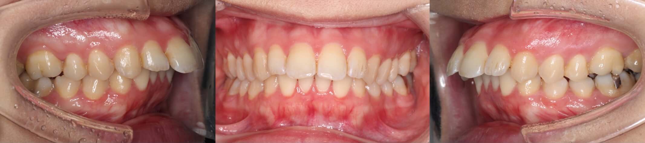 ハーフリンガル・出っ歯治療症例