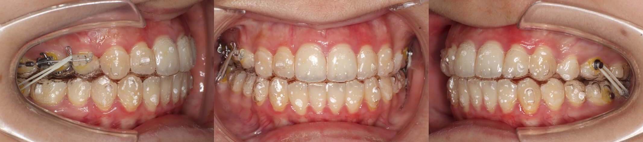 インビザライン抜歯・失敗リカバリー治療