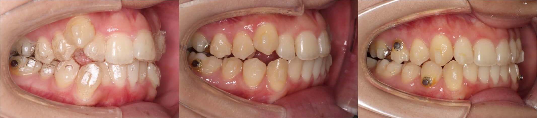 八重歯・インビザライン拡大治療例