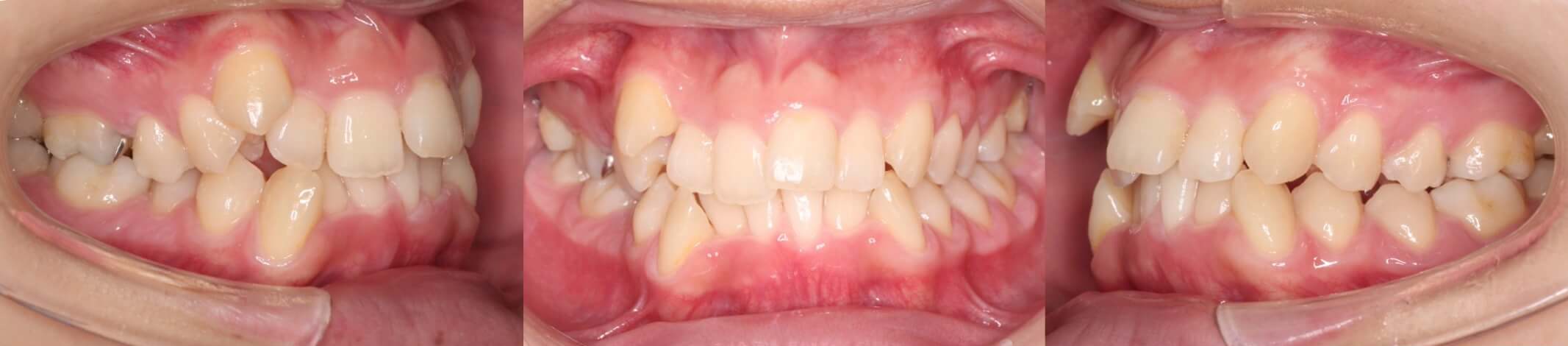 八重歯・インビザライン拡大治療例