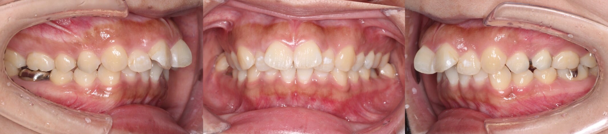 ハーフリンガル・出っ歯治療症例