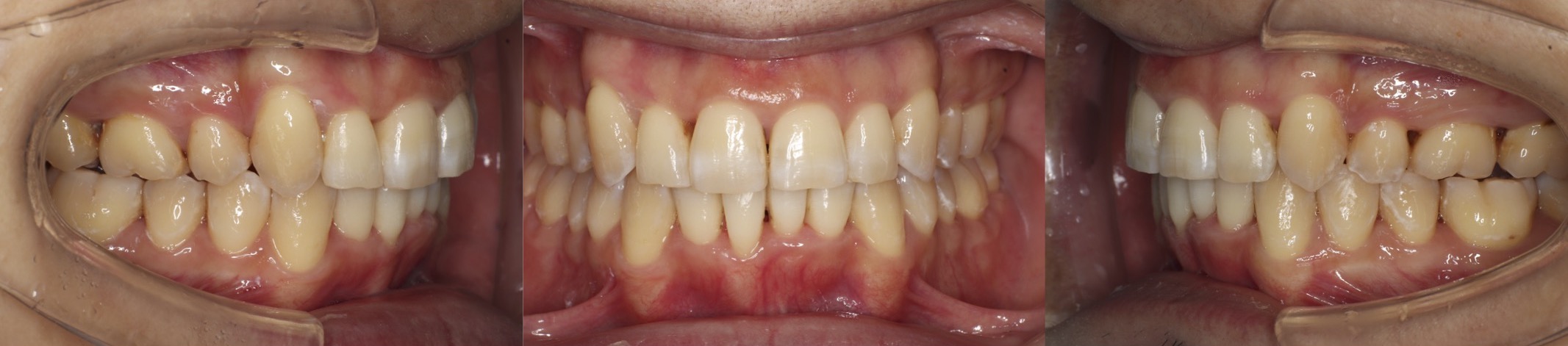 八重歯・インビザライン抜歯治療例