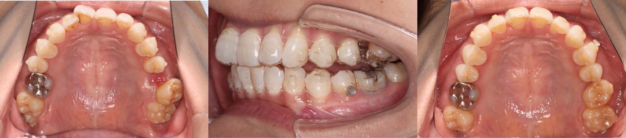 大臼歯抜歯・インビザライン矯正治療