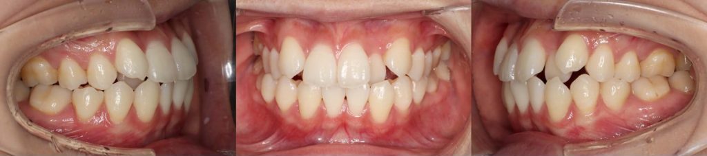 インビザライン・先欠歯・抜歯治療例
