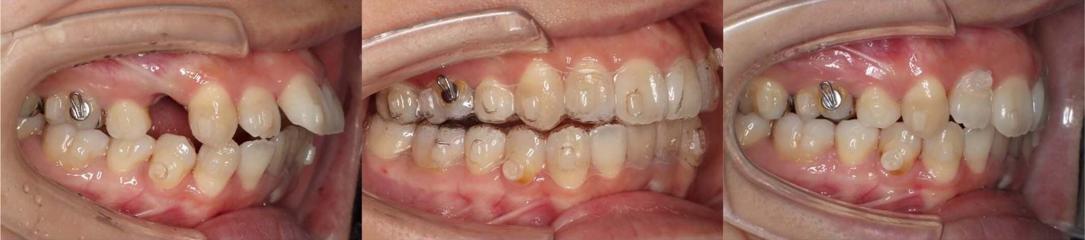 出っ歯・インビザライン治療症例