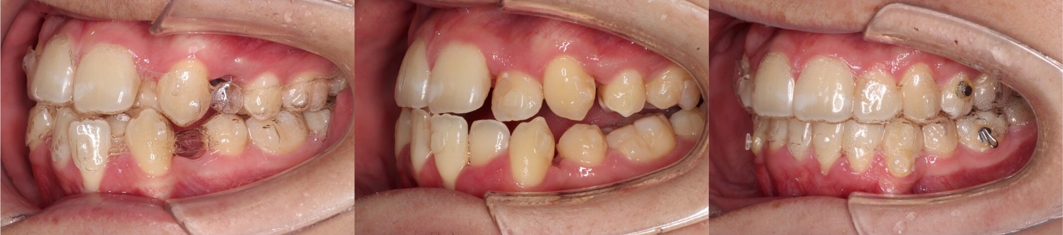 歯肉退縮治療・インビザライン