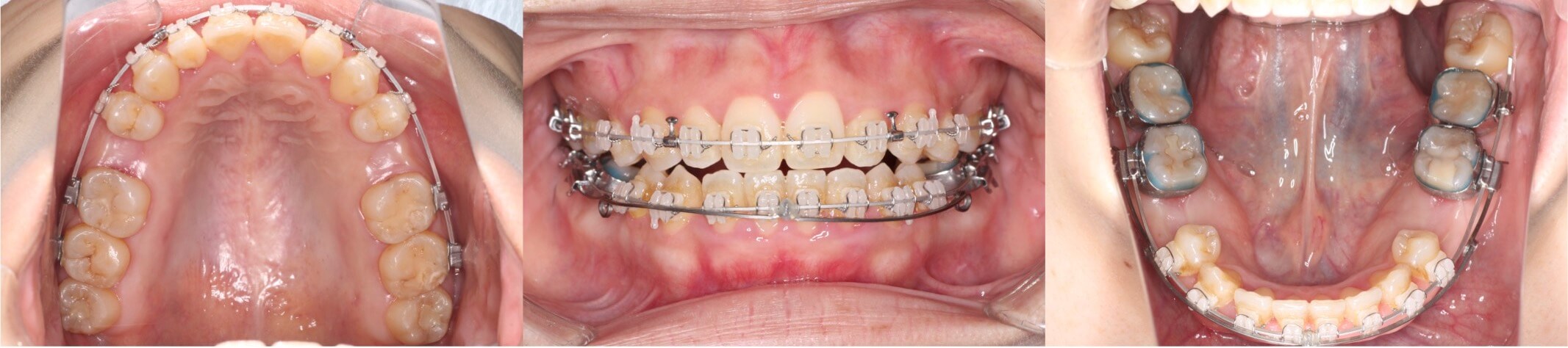 5番先欠歯・矯正治療
