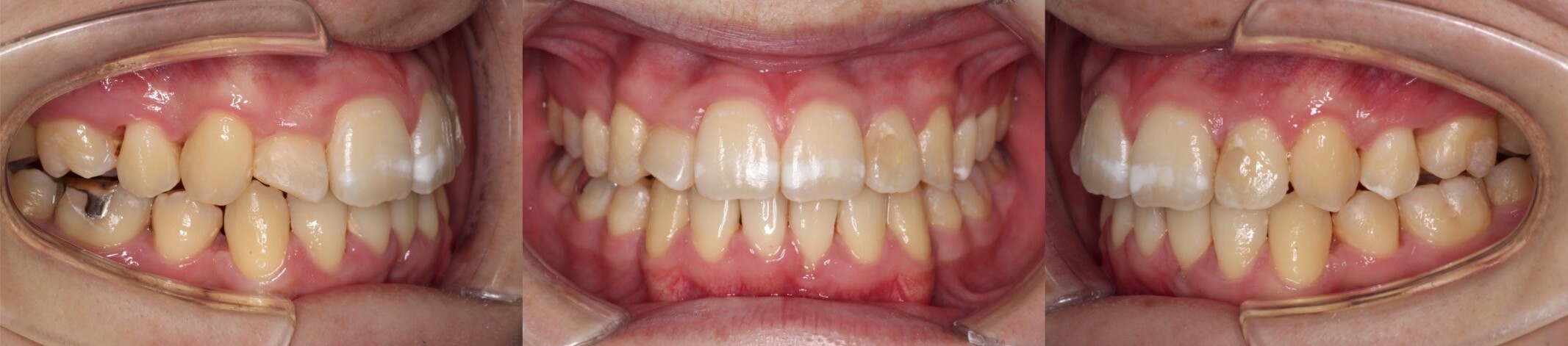 歯肉退縮治療・インビザライン