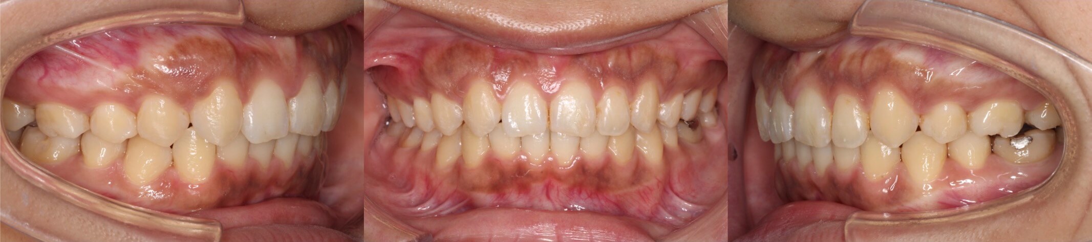 インビザライン・乳歯抜歯治療例