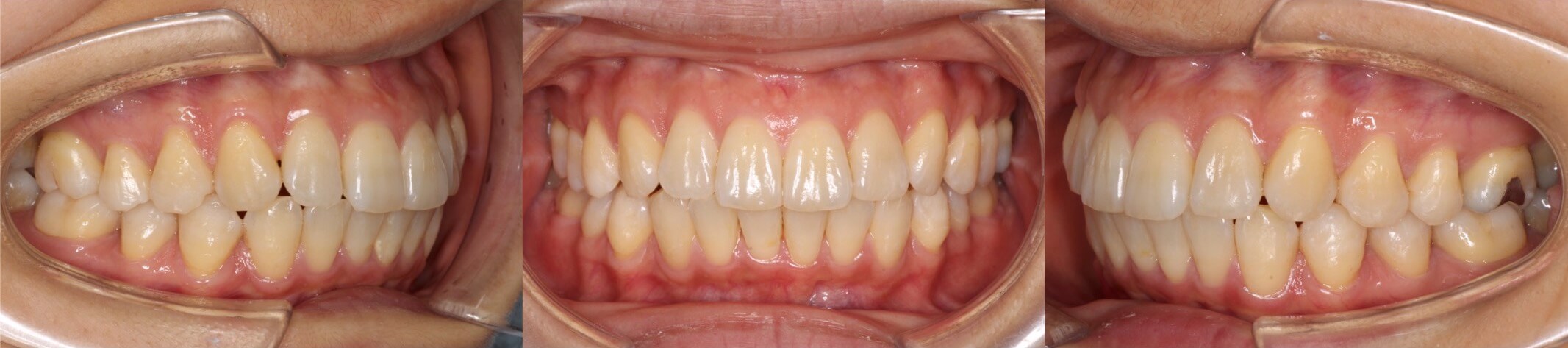 インビザライン・上顎前突非抜歯症例