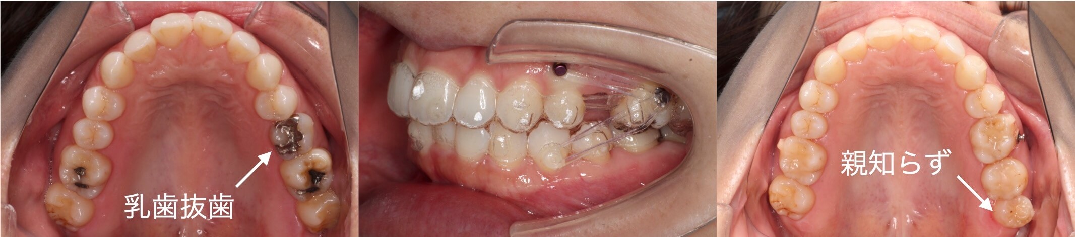 インビザライン・乳歯抜歯治療例